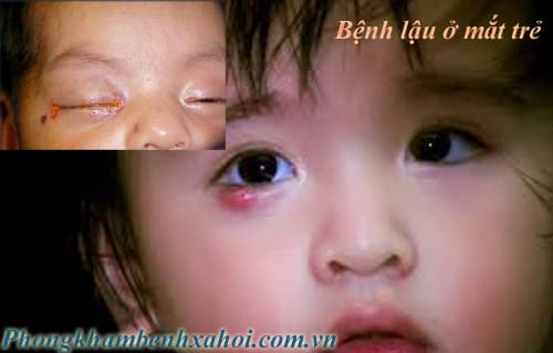 Bệnh lậu ở mắt trẻ sơ sinh