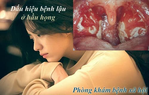 Dấu hiệu triệu chứng bệnh lậu ở hầu họng miệng